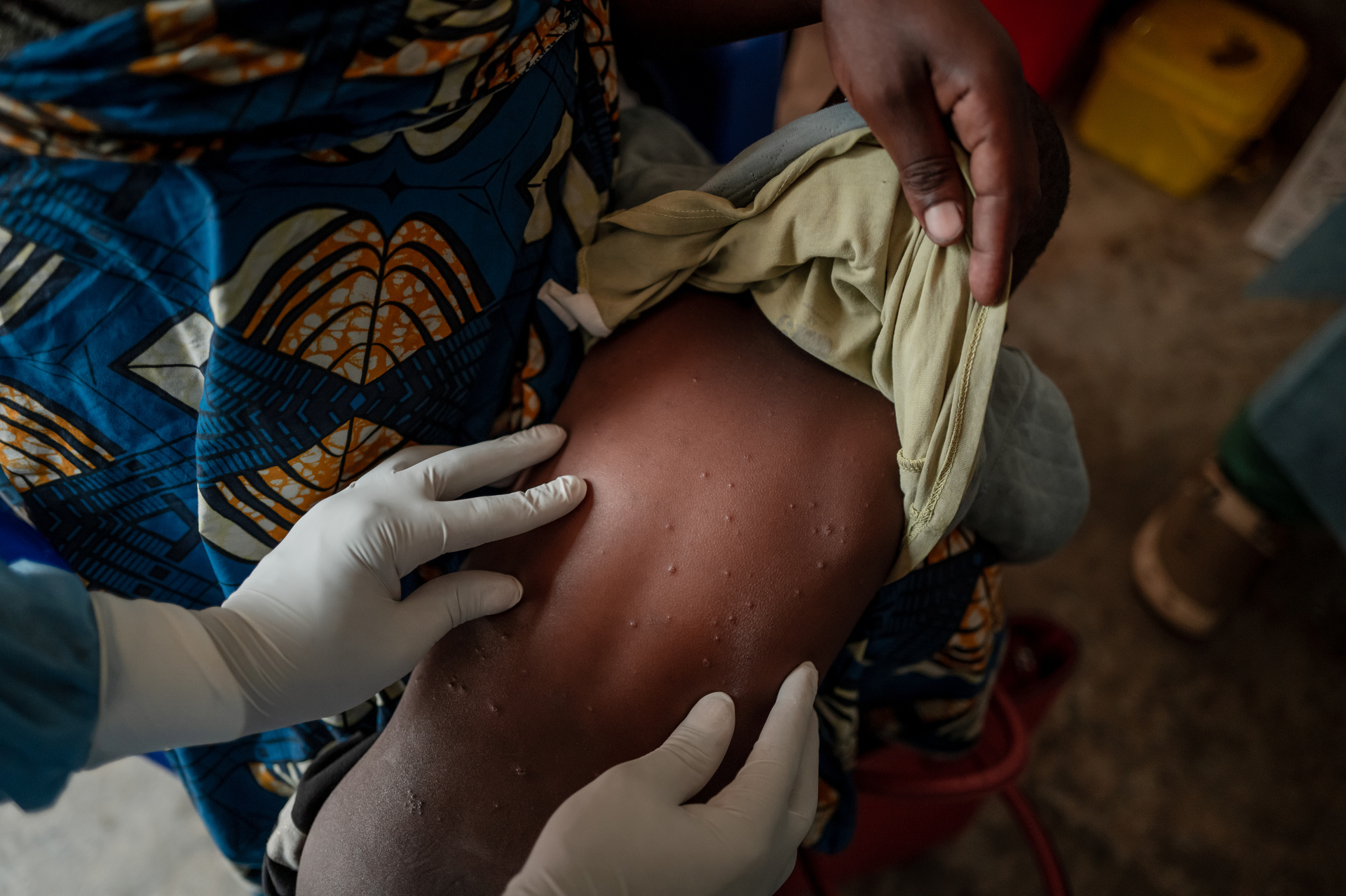 Компания Mpox бросает вызов новому фонду Gavi по борьбе с пандемиями
